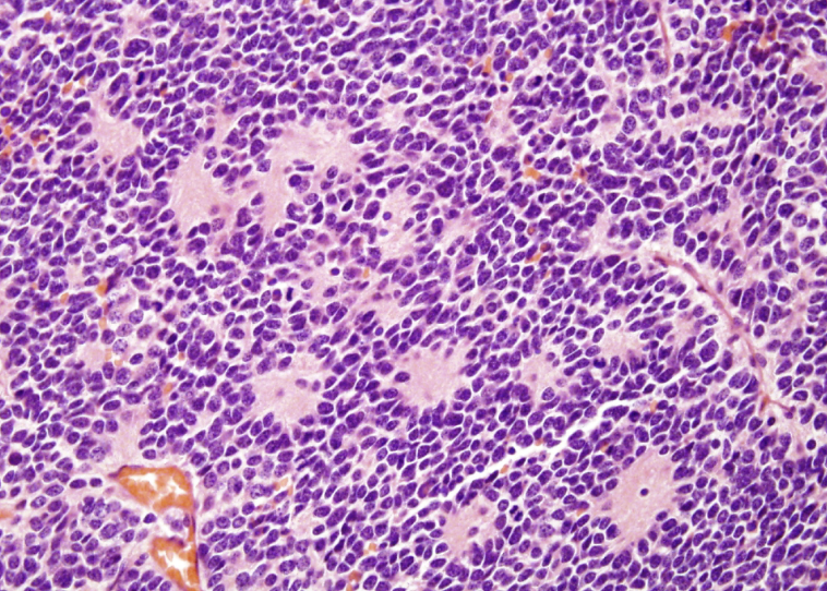 <p>small round blue cell tumor in the abdomen of a child with homer-wright pseudorosettes</p>