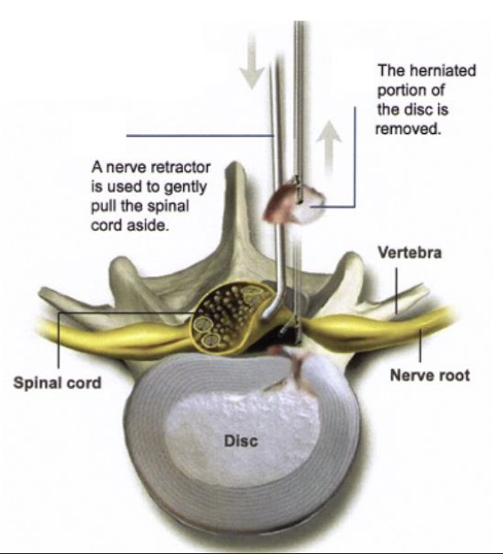 <p>1. Rest, physical therapy, pain medications</p><ul><li><p>85% resolve in 8-12 weeks</p></li></ul><p>2. Surgical – Discectomy/Microdiscectomy</p><ul><li><p>Conservative failed to resolve</p></li><li><p>Progressive/debilitating pain, numbness, and weakness</p></li></ul><p></p>