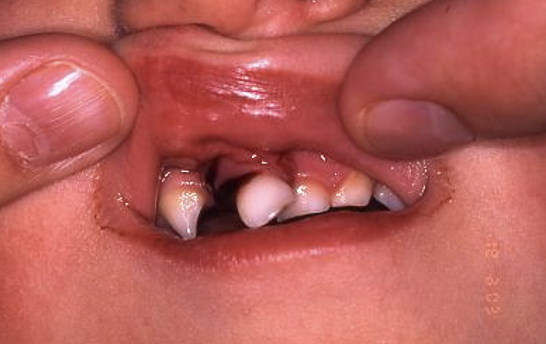 <p>luxation: loosening of tooth involving tooth movement</p><p></p><ul><li><p>photo: lateral luxation</p></li></ul><p></p>
