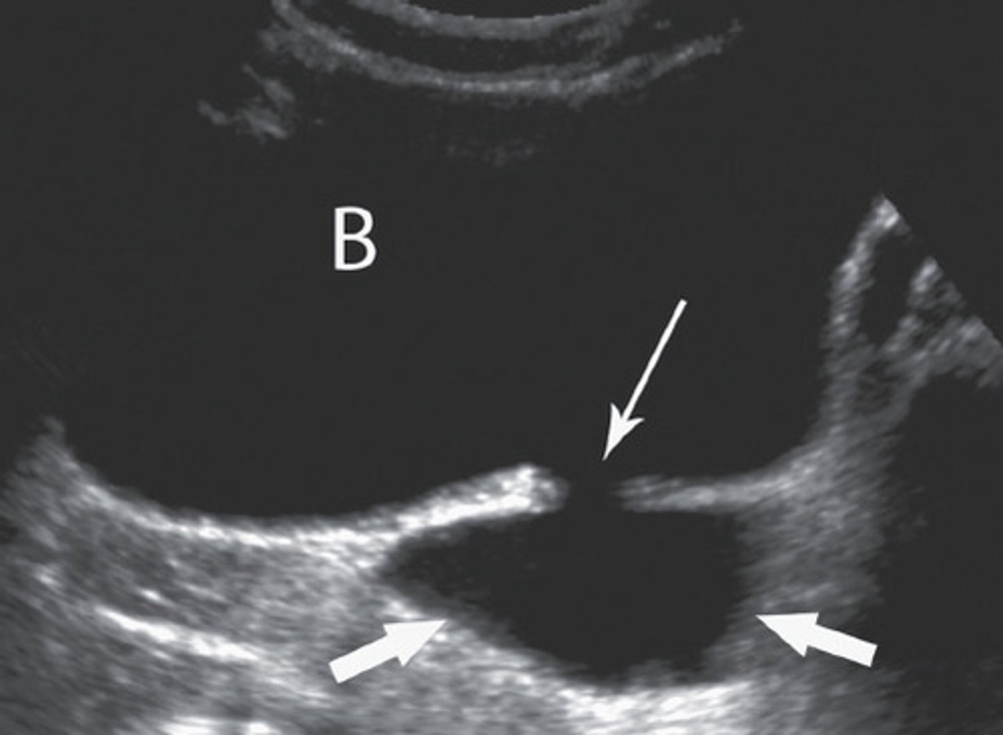 <p>bladder diverticulum</p>