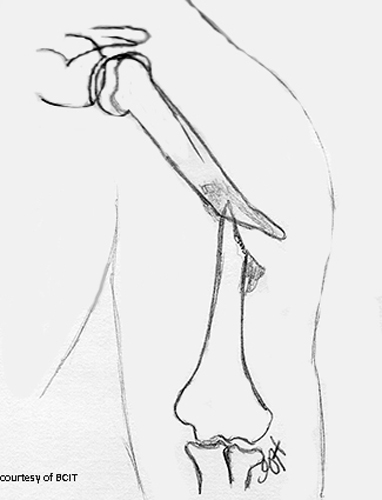 <p>What nerve is at risk in humeral shaft fractures?</p>