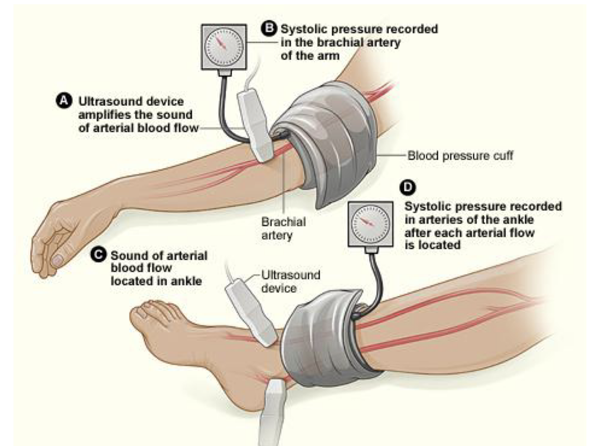 <ul><li><p>Purpose:</p><ul><li><p>To distinguish LE Neurogenic vs Vascular Claudication Pain</p></li></ul></li><li><p>Compares:</p><ul><li><p>Ratios of SBP of Arms and Legs</p><ul><li><p>L Leg Systolic / Highest Brachial BP</p></li><li><p>R Leg Systolic / Highest Brachial BP</p></li></ul></li></ul></li><li><p>Doppler:</p><ul><li><p>Posterior Tibial Artery</p></li><li><p>Dorsalis Pedis Artery</p></li></ul></li></ul><p></p>