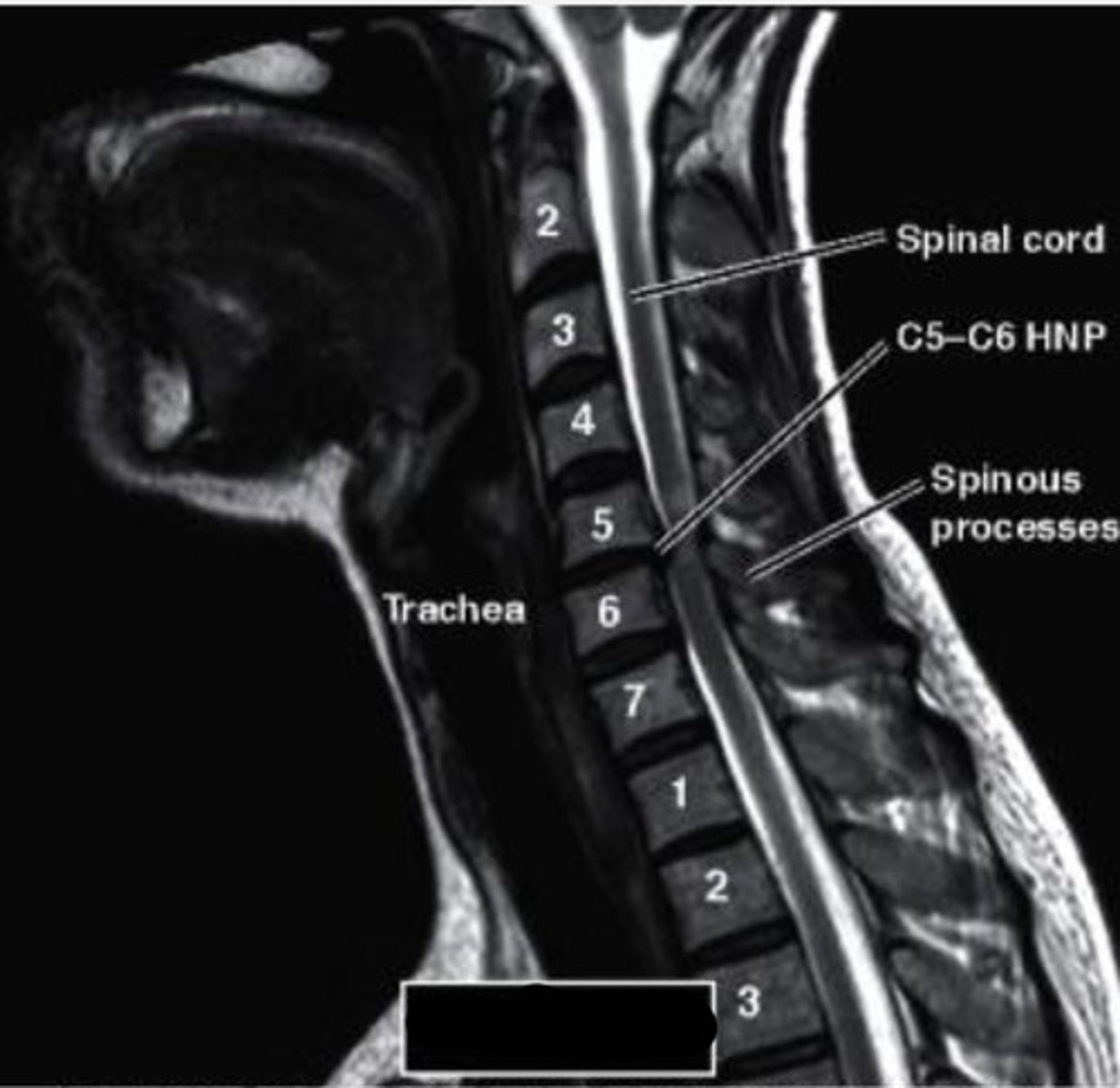 <p>What type of MRI view does this show?</p>