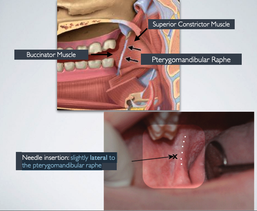 <p>slightly lateral to the pterygomandibular raphe</p>