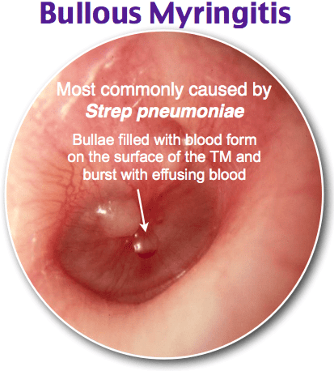 <p>Small vesicles containing blood on the drum; accompany mycoplasma pneumonia and virus infections</p><p>PAINFUL HAEMORRHAGIC BLISTERS OF TYMPANIC MEMBRANE </p>