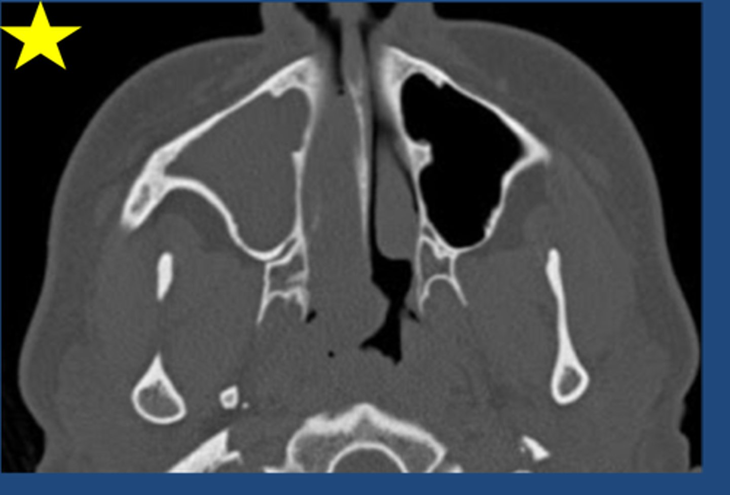 <p>Identify the radiographic abnormality. (Note the extension from the left maxillary sinus into the nasal cavity and through the choana)</p>