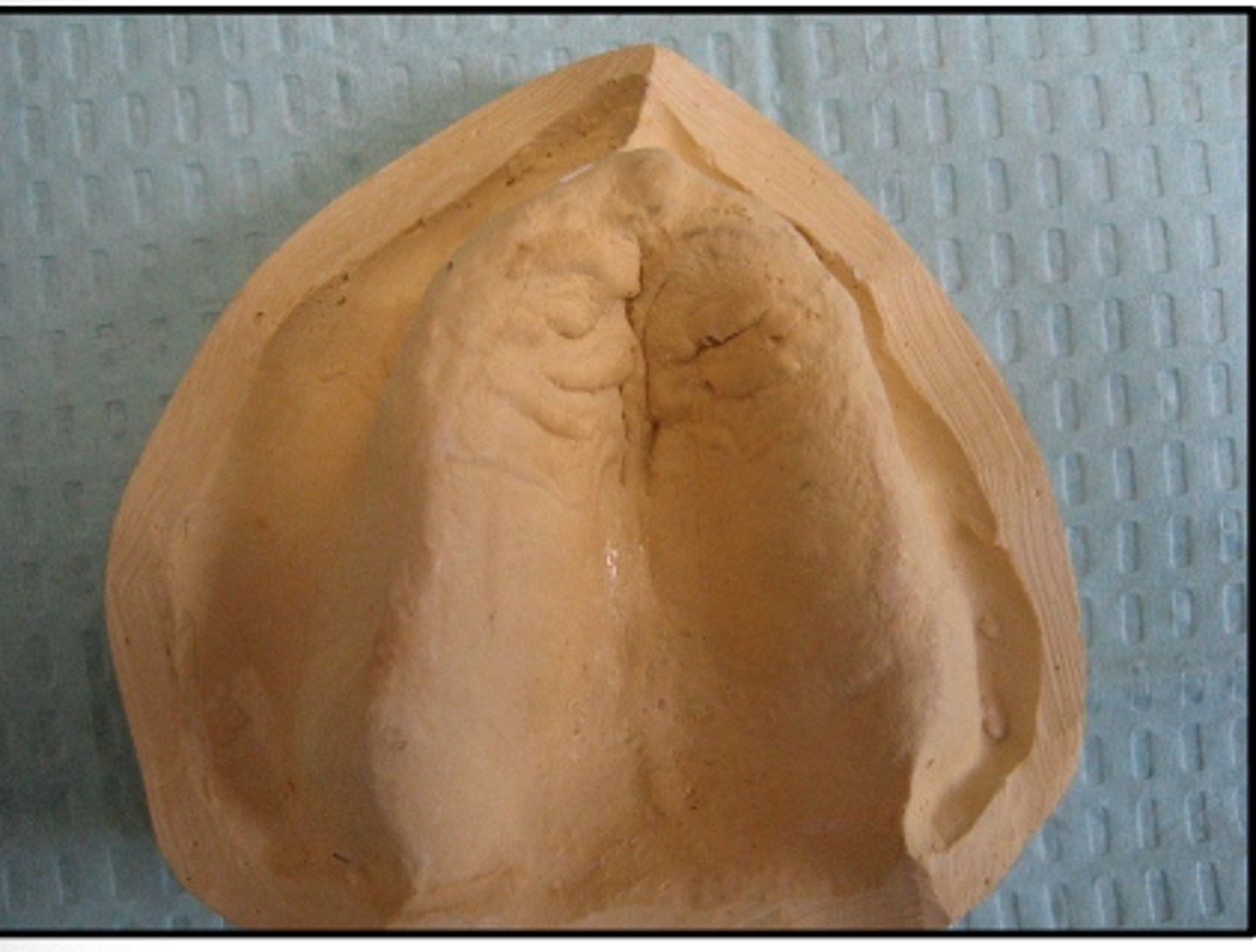 <p>This is what type of residual ridge shape?</p>