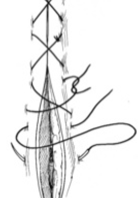 <p>What suture pattern is shown in the image?</p>