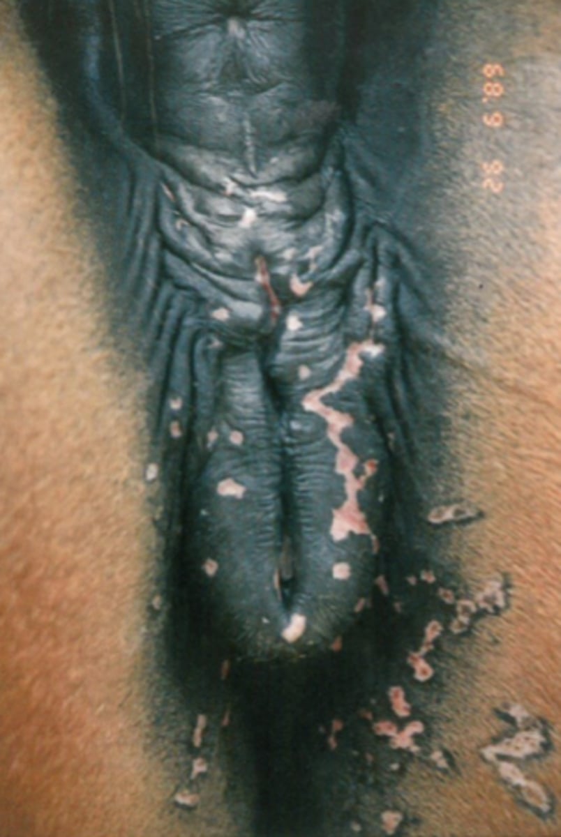 <p>Hvad har forårsaget læsionerne på hoppens vulva?</p><p>- Afvaskning med iod</p><p>- Equin Herpes virus 3</p><p>- Afvaskning med 5% klorhexidin</p><p>- Taylorella Equigenitalis</p>