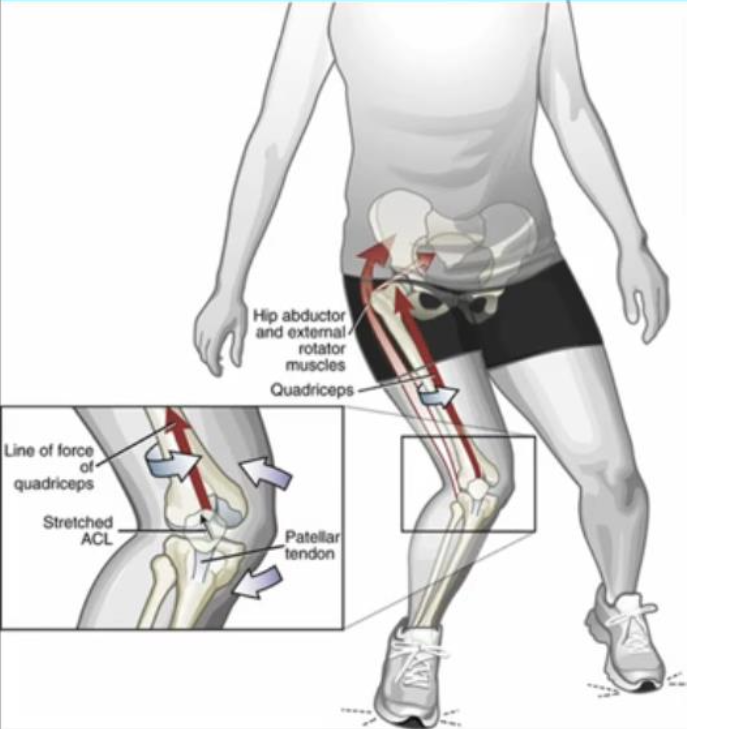 <ul><li><p>Strong quad activation over a slightly flexed knee</p></li><li><p>Valgus collapse</p></li><li><p>Excessive ER + planted foot</p><ul><li><p>Femur IR on fixed tibia</p></li></ul></li><li><p>Knee IR + Ext + Valgus</p></li><li><p>Excessive Hyperextension + Planted foot</p></li></ul><p></p>