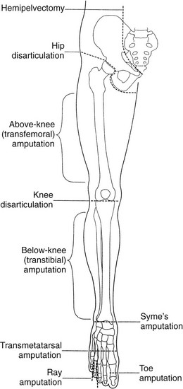 <ol><li><p>hemipelvectomy: half of pelvis and entire LE</p></li><li><p>hip disarticulation: at hip joint</p></li><li><p>above knee: any level on thigh</p></li><li><p>knee disarticulation: at knee joint</p></li><li><p>below knee: any level on calf</p></li><li><p>ankle (syme)</p></li><li><p>ray (metatarsal)</p></li><li><p>transmetatarsal</p></li><li><p>complete phalanges</p></li></ol><p></p>