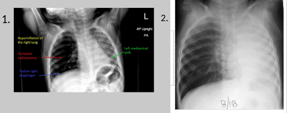 <p>intrabronchial foreign body</p>
