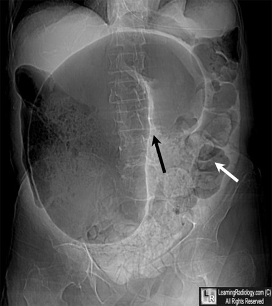 <p>Colonic Volvulus may appear as the __________</p>