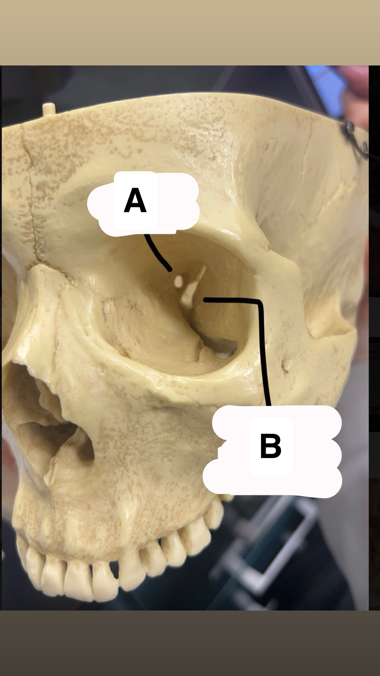 <p>What is “B” and what cranial nerve(s) run through it?</p>