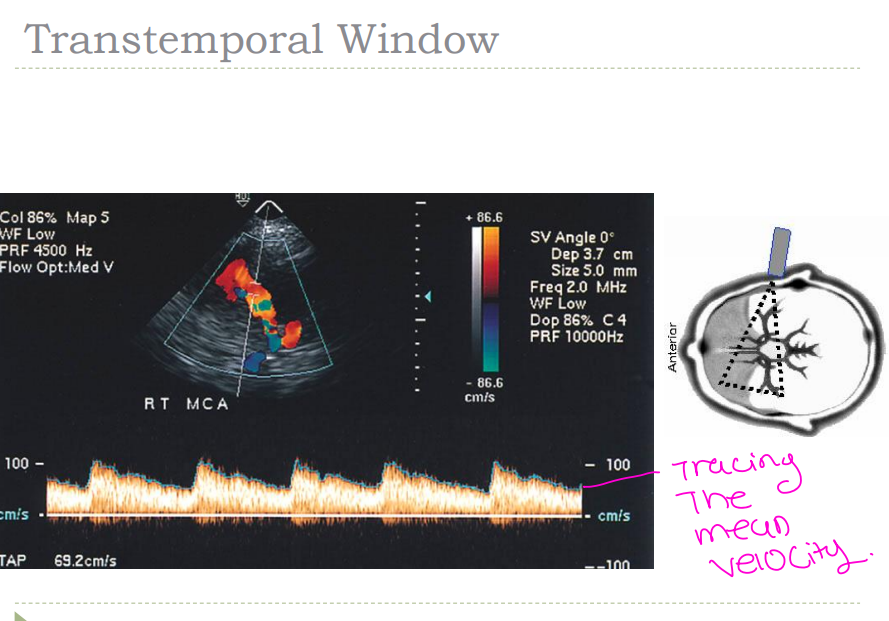 <p>Depth 30 – 60 mm  </p><p>Flow direction – Antegrade; toward </p><p> Mean velocity- 55 + 12 cm/sec  </p><p>Angle – anterior and superior  </p><p>Courses adjacent to sphenoid wing  </p><p>Branches usually in red, but may be blue as they curve away from transducer</p>