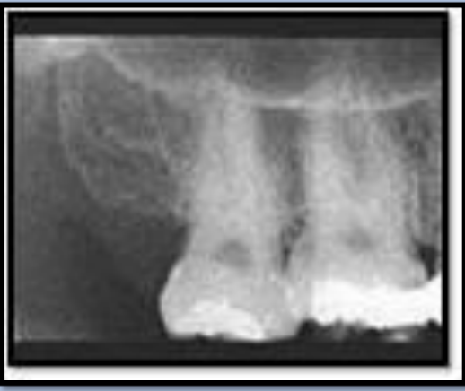 <ul><li><p>Radiopaque </p></li><li><p>Ex. Maxillary Tuberosity </p></li></ul><p></p>
