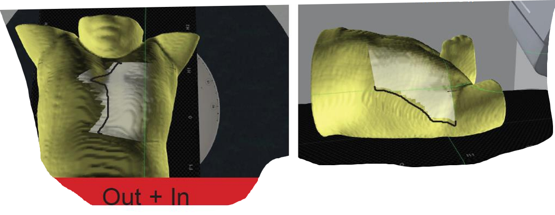 <p>if our field light was out medially and in laterally, what does that tell us about our patient’s positioning</p>