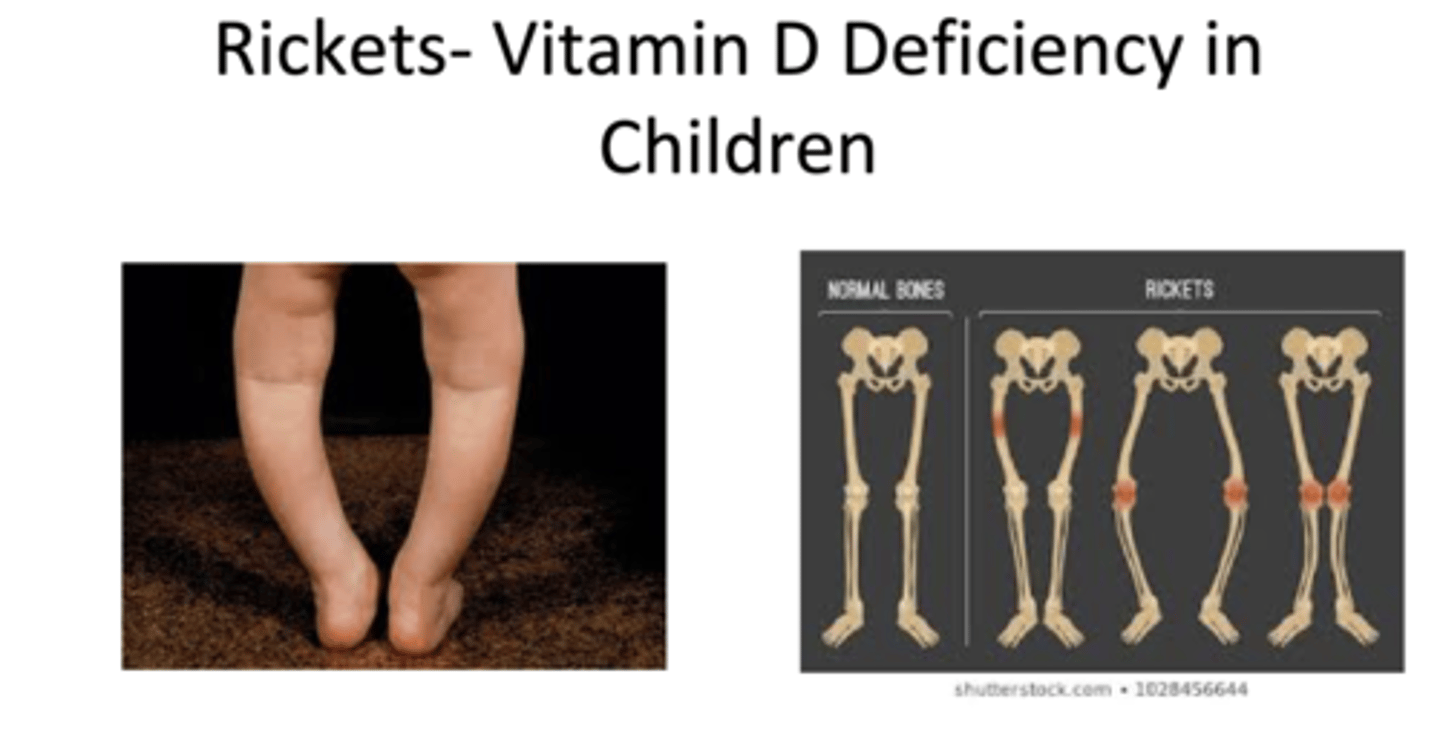 <p>Children = Rickets</p><p>Adults = Osteomalacia</p>