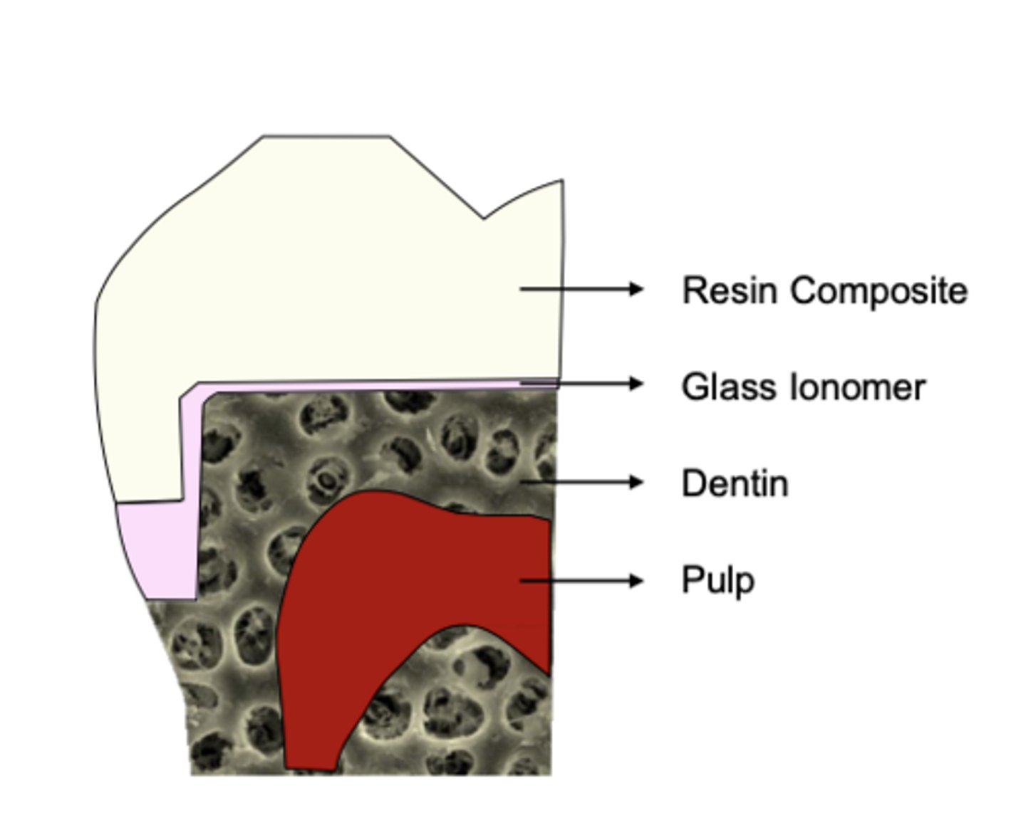 <p>Layers of GI (conventional or resin modified) between dentin and permanent restorative material (resin-based composite)</p>