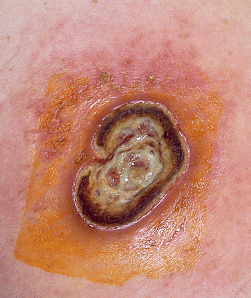 <p>ein münzgroßes Hautgeschwür;scharfrandig begrenzt, durch Bakterien verursacht</p>