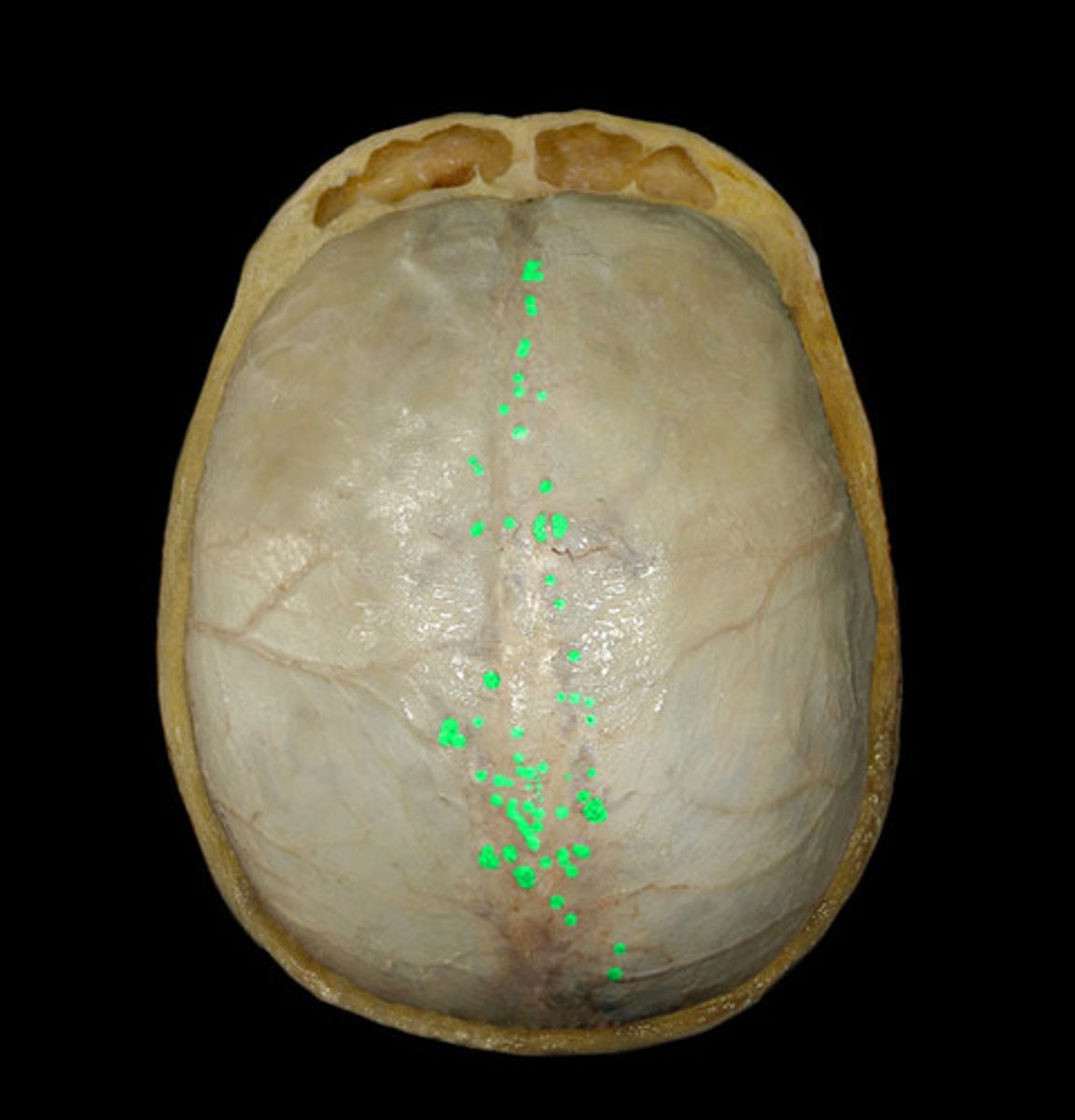 <p>what creates these small dents in the skull</p>