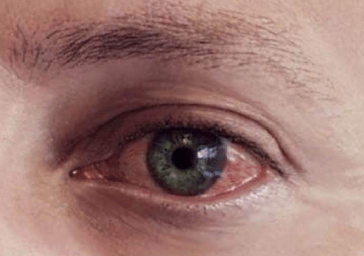 <p>Pink eye</p>