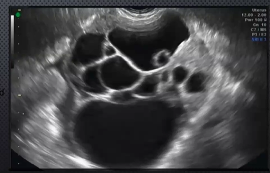 <ul><li><p>40 - 70 yrs</p></li><li><p>leads to pseudomyxoma peritone (<strong>ascites </strong>thick)</p></li><li><p>large, multiloculated, <strong>THICK,</strong> irregular walls</p></li><li><p><strong>menopausal women 10% </strong></p></li><li><p><strong>pelvic pressure</strong></p></li><li><p><strong>pain when ruptured</strong></p></li><li><p>bloating</p></li><li><p>weight loss</p></li></ul><p></p>