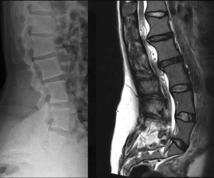 <p>what is seen here for this case of achondroplasia?</p>