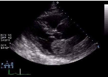 <p><span>The image above demonstrates a benign primary cardiac tumor.&nbsp; The most likely diagnosis is which of the following?</span></p><p></p><p>right atrial myxoma</p><p>&nbsp;</p><p>left atrial myxoma</p><p>&nbsp;</p><p>right atrial hemangioma</p><p>&nbsp;</p><p>left atrial hemangioma</p>