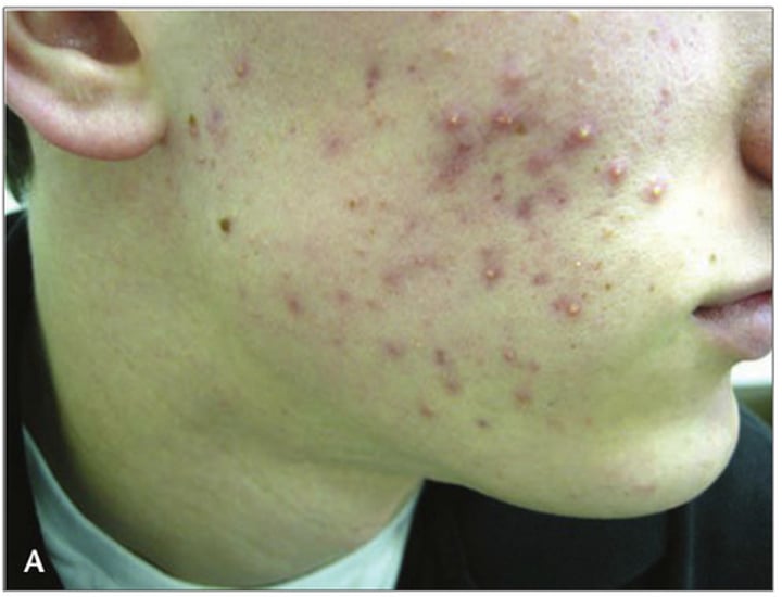 <p>•the occurrence of inflamed/infected sebaceous glands in the skin; (condition characterized by red pimples on the face, prevalent chiefly among teenagers.)</p>