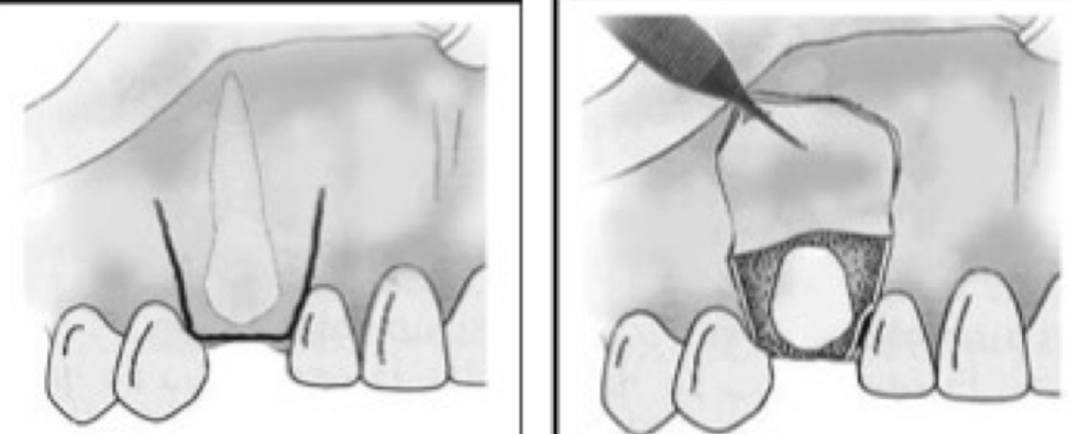 <p><strong>help eruption</strong><span> by exposing the crown </span><strong>after removing any obstacle</strong></p><p><span>Canines in a </span><strong>favorable position</strong><span> that </span><strong>still have eruptive potential</strong></p><p>A <strong>buccal or palatal flap</strong> is raised from the root area toward the desired canine position, ostectomy exposes crown, tooth can erupt naturally </p>