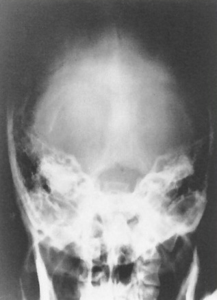 <p>What is this x-ray demonstrating?</p>
