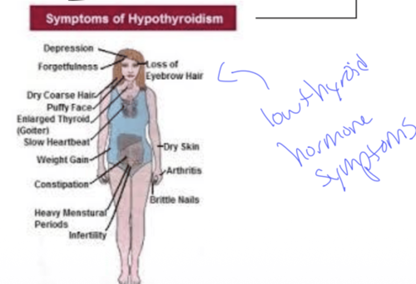 <p>A: Thyroid tissue is destroyed → unable to make thyroid hormones (hypothyroid)</p>