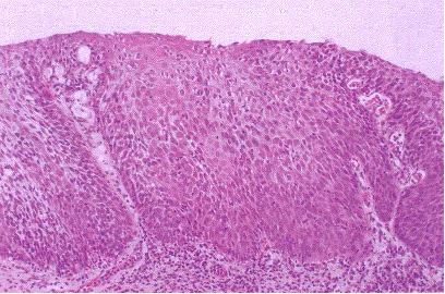 Bowens Disease

(Carcinoma In-Situ; Erythroplasia of Queyrat)