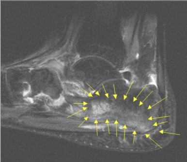 <p>Heel contusion</p>