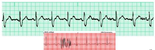 Large spikes caused by muscle movement

Causes: shivering, muscle tension, pain, fear, talking,  \n chewing gum, disorders such as Parkinson’s disease.