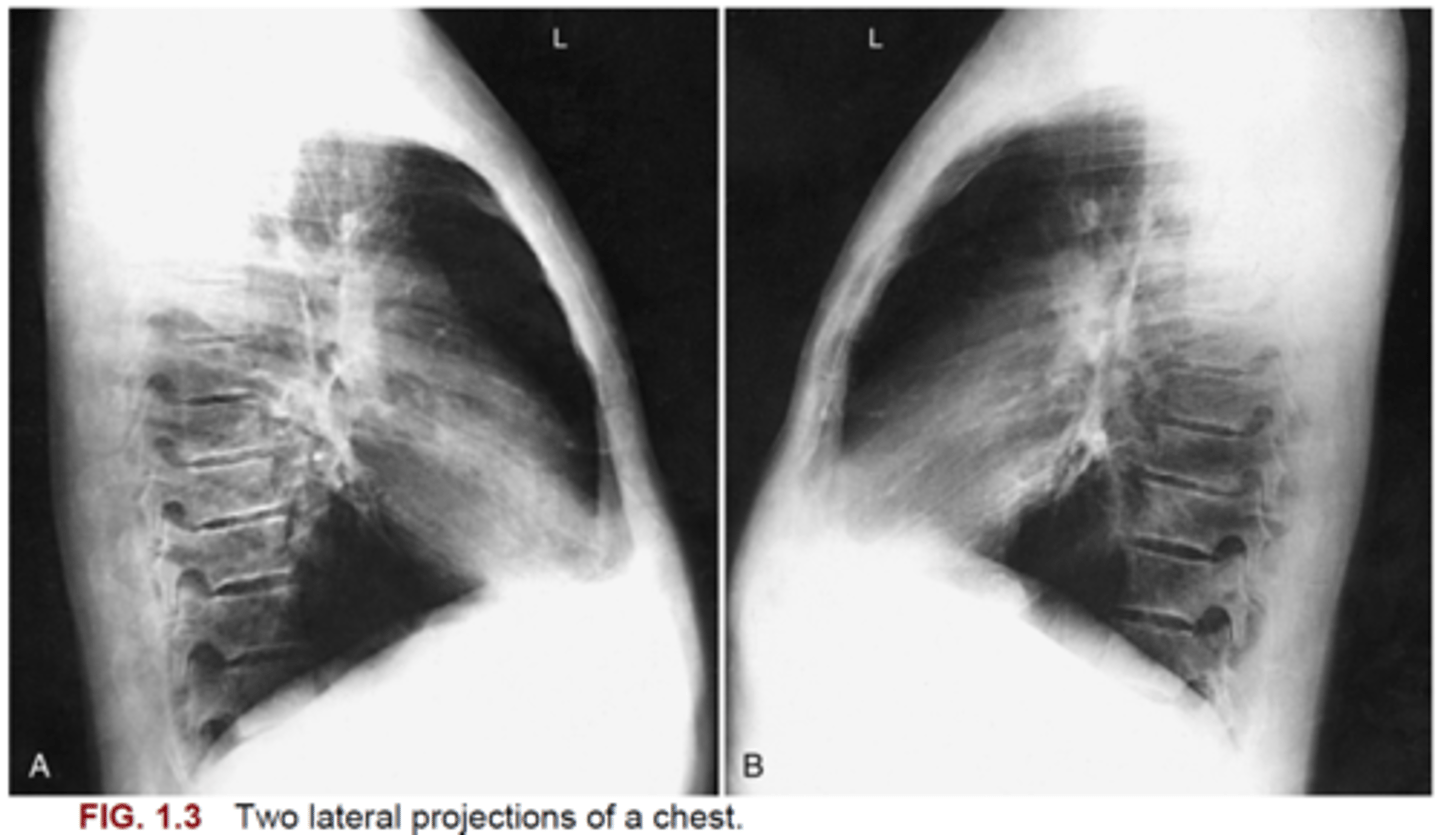 <p>71. Fig. 1.3 shows two lateral projection chest radiographs. Which image (A or B) is correctly displayed as a left lateral chest radiograph?</p>