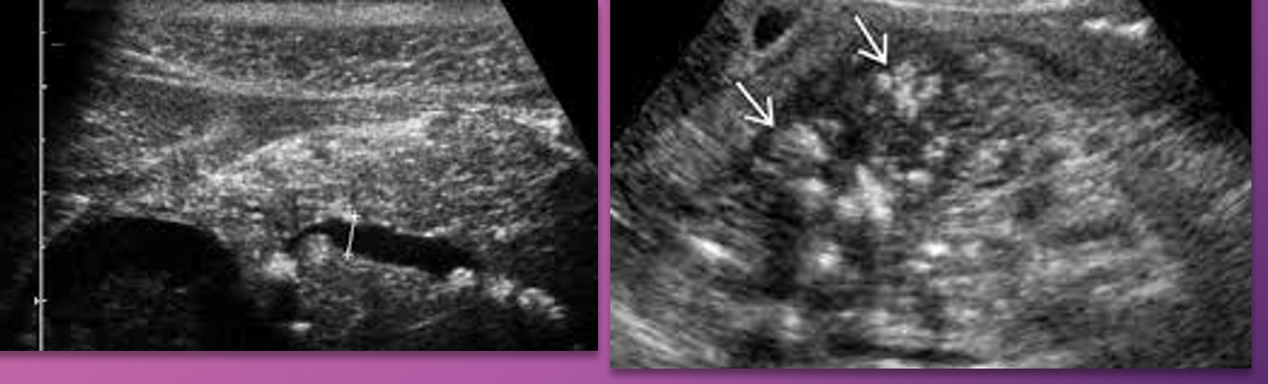 <p>What is a classic finding of chronic pancreatits?</p>