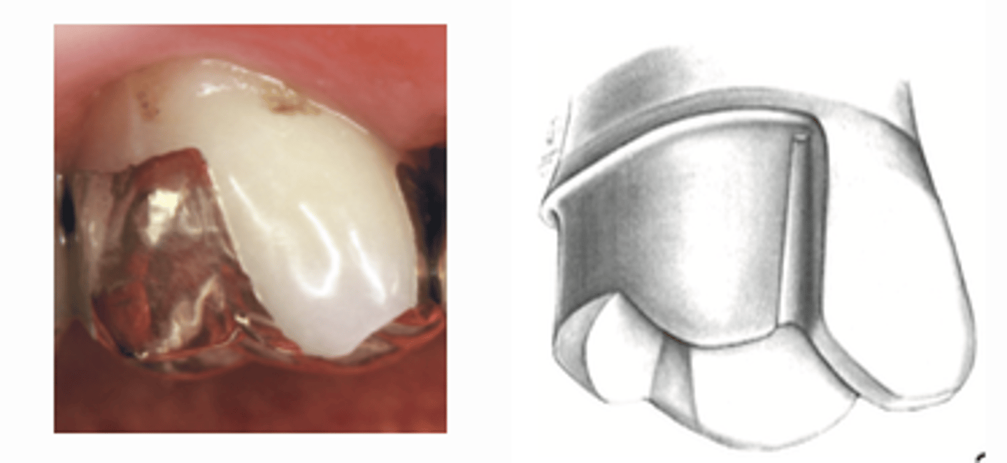 <p>What type of cast partial coverage restoration?</p>