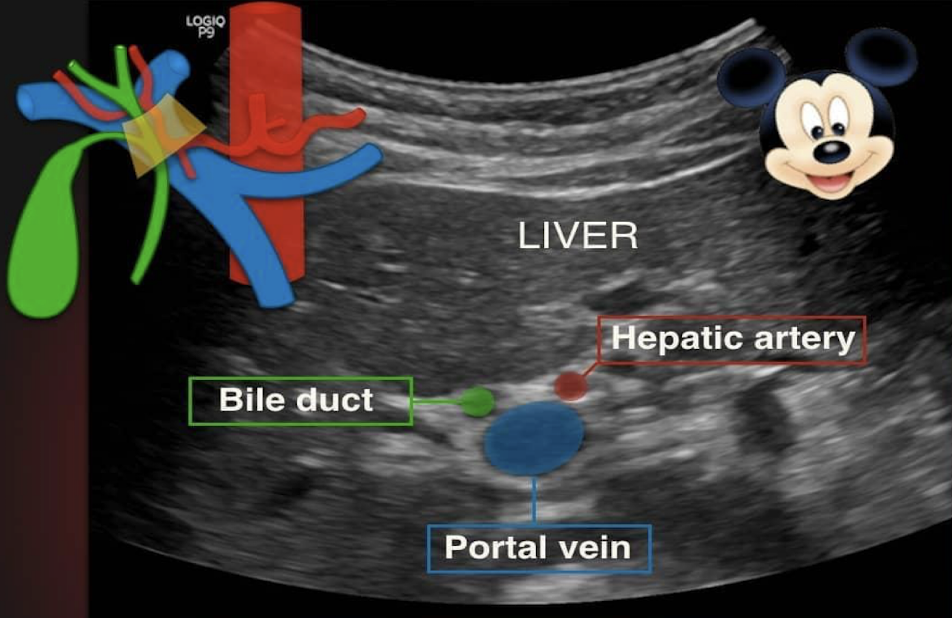 <ul><li><p>portal vein (head)</p></li><li><p>duct (right ear)</p></li><li><p>hepatic artery (left ear)</p></li></ul><p></p>