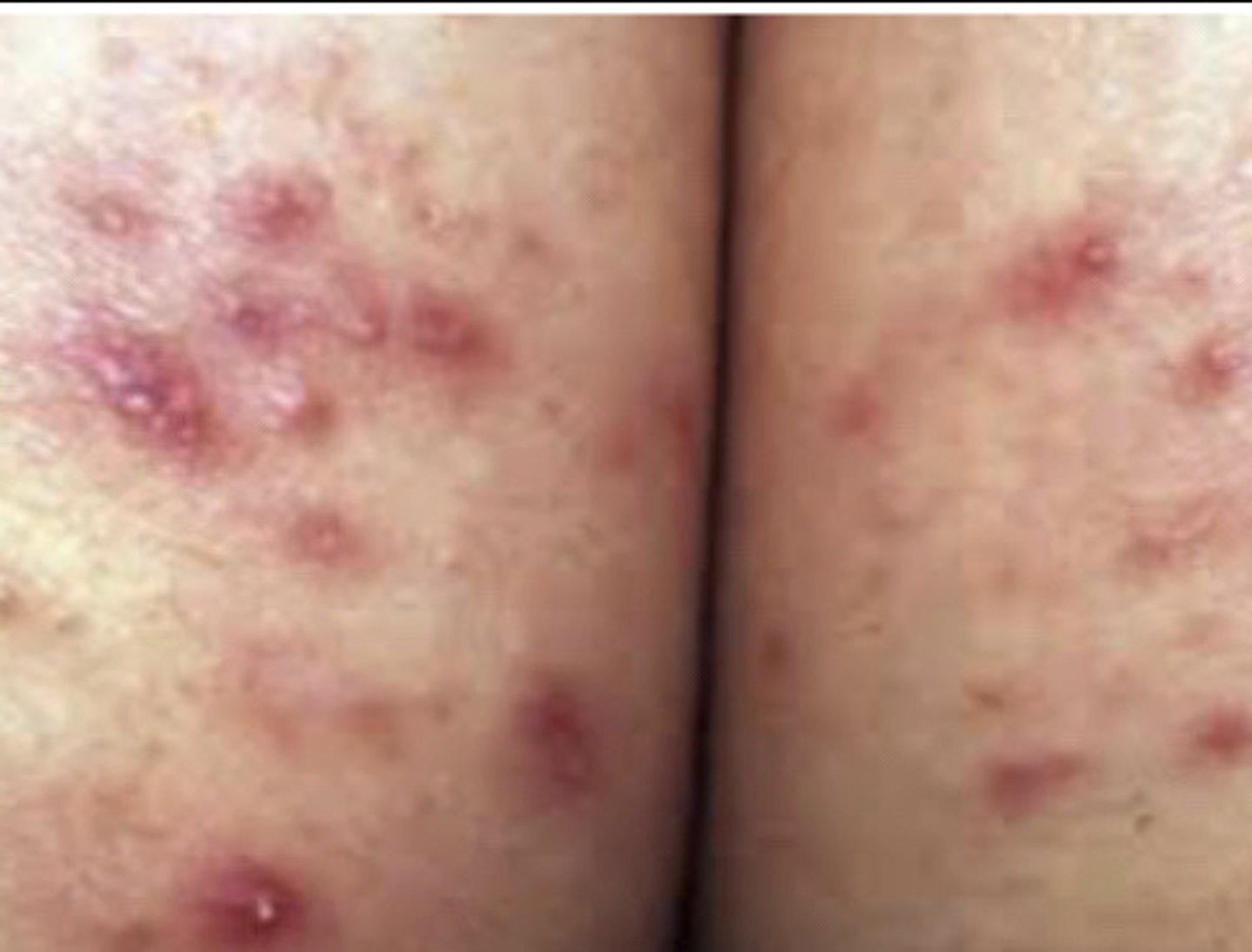 <p>Pityrosporum Folliculitis</p>