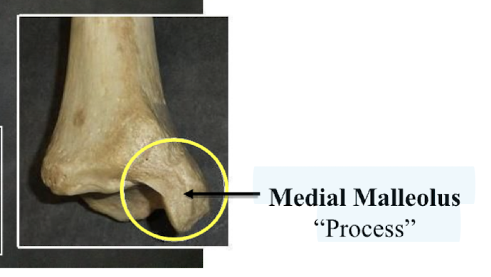 <p>Medial Malleolus </p>