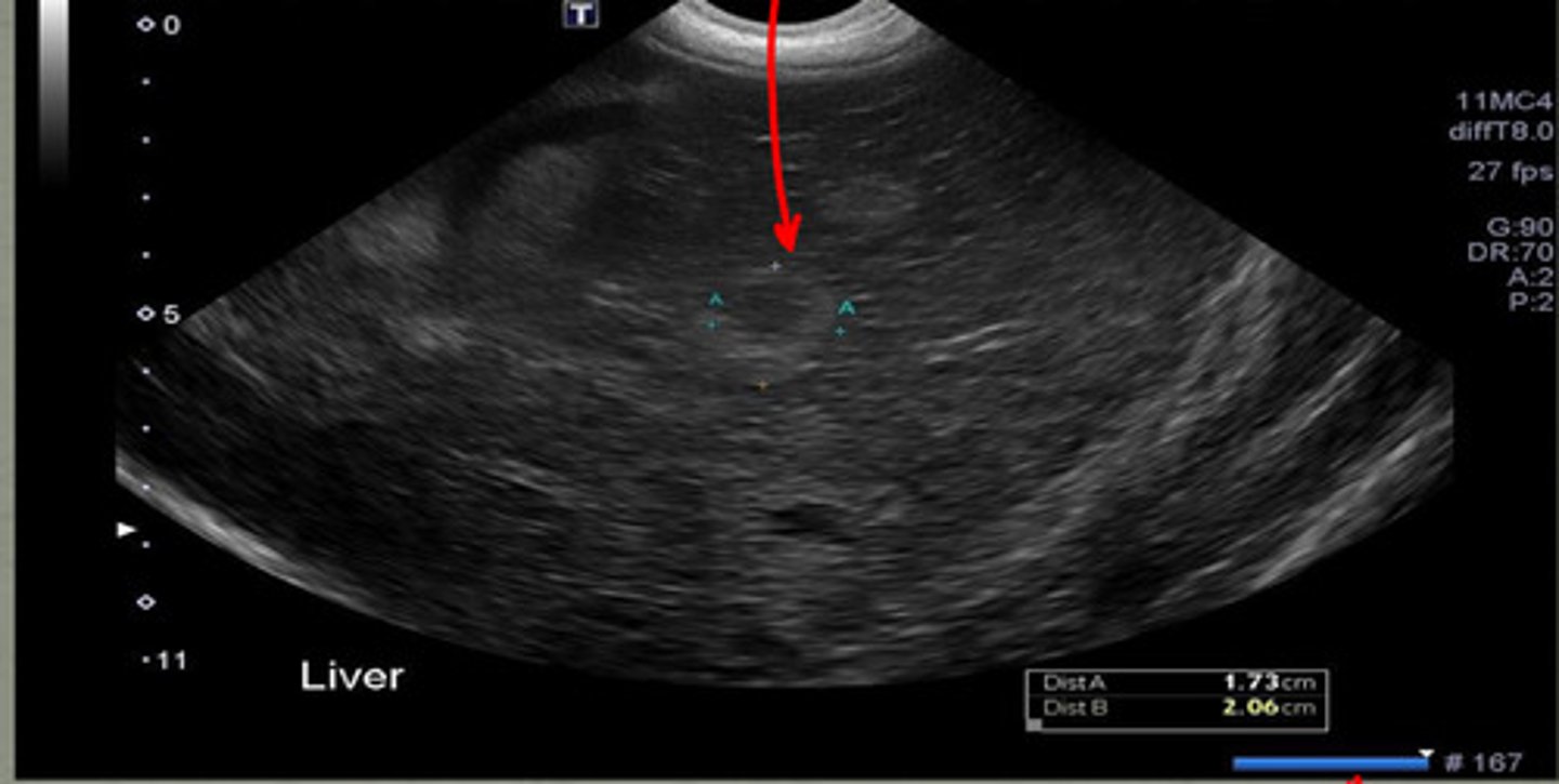 <p>what is the red arrow indicating from this ultrasound of the liver?</p>