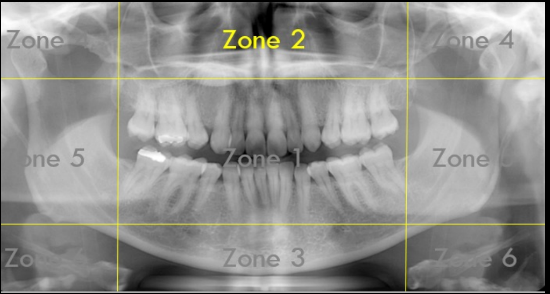 <p>Zone 2: Nasal Cavity and Maxillary Sinuses</p>
