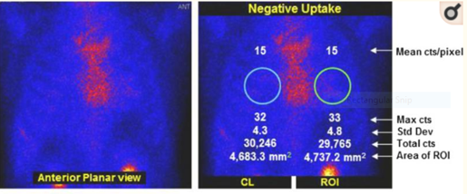 <p>does this image show negative or positive uptake</p>