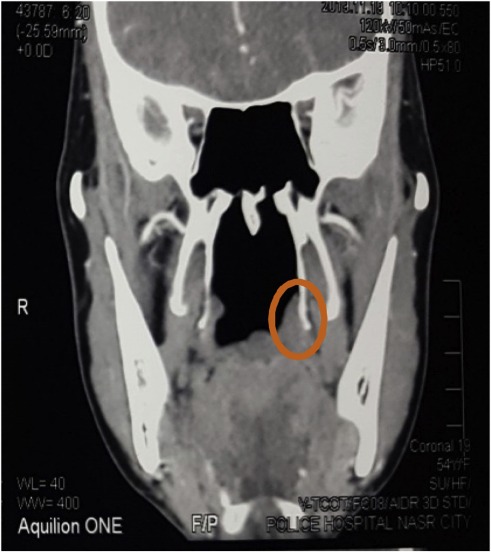 <p>Inferior portion of medial pterygoid plate; Where tensor veli palatini hooks around</p>