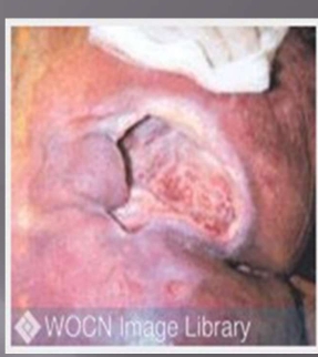 <p>Pressure Injury Stage 4 </p>