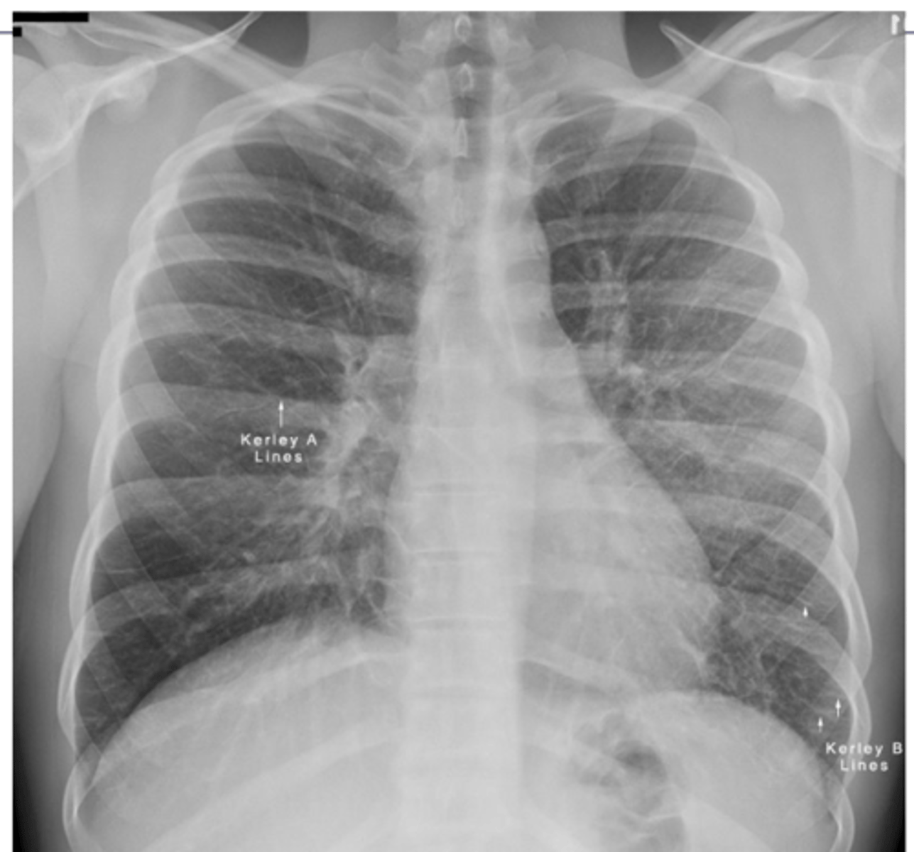 <p>•Kerley A lines are linear opacities extending from the periphery to the hila caused by distention between peripheral and central lymphatics</p><p>•Kerley B lines are small, horizontal, peripheral straight lines demonstrated at the lung bases that represent thickened interlobular septa on CXR.</p>