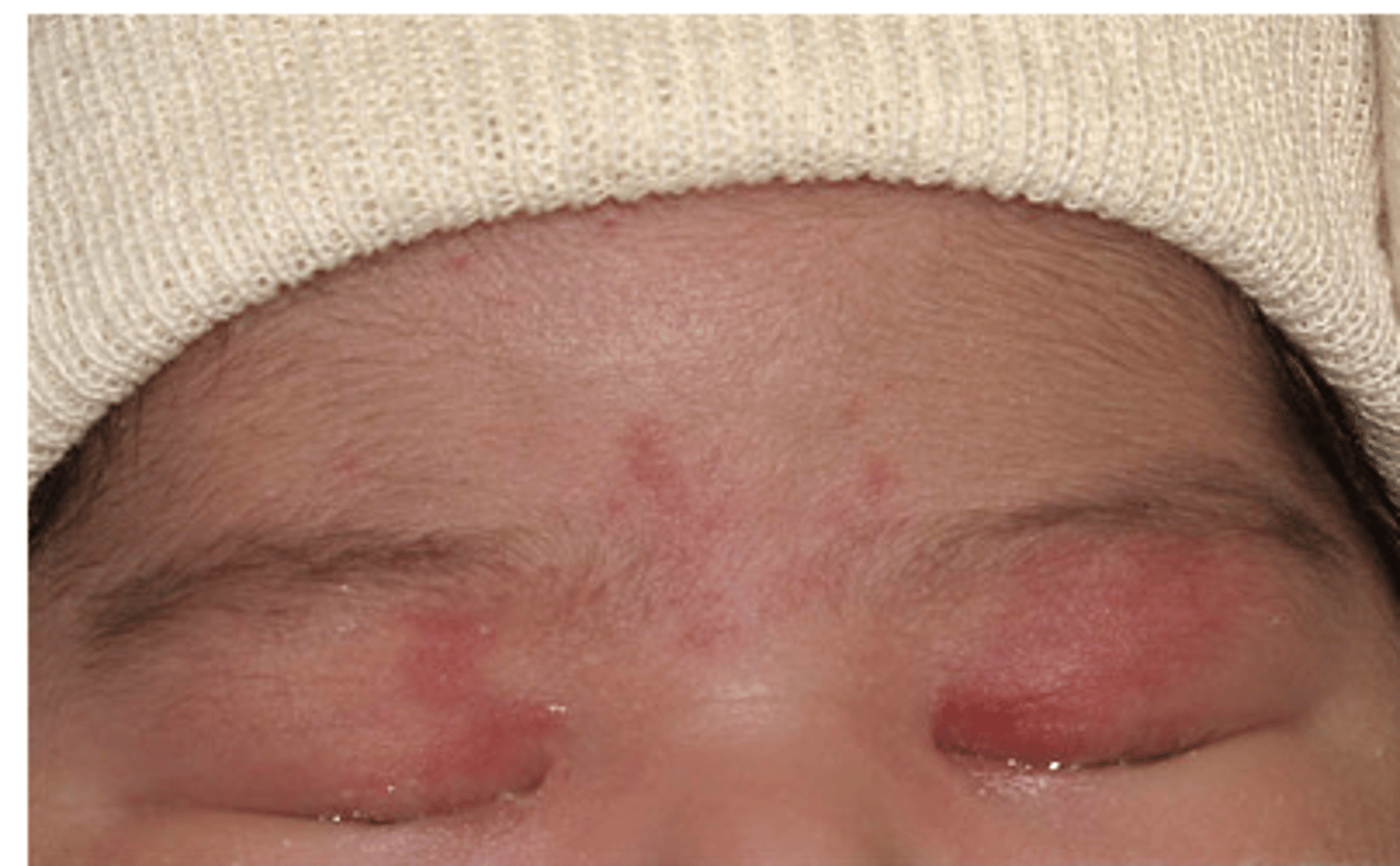 <p>- type of capillary malformation</p><p>- blanchable, pink/red macular patches</p><p>- gradually fade over time</p>