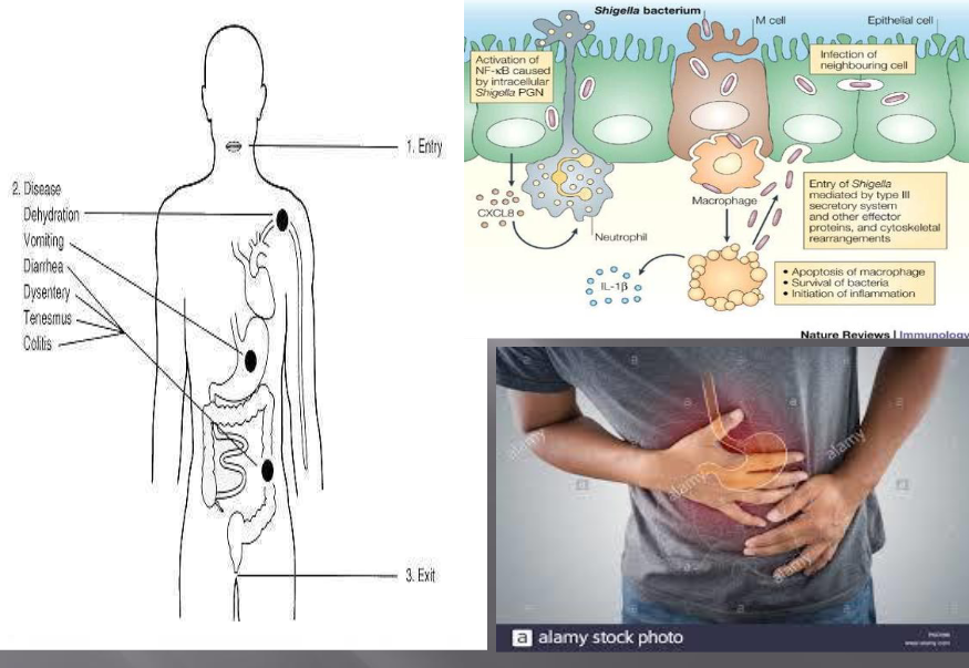 <ul><li><p><span><span>колит, диария, тенезми (непродуктивни<br>болезнени напъни за дефекация)</span></span></p></li><li><p><span><span>обща слабост</span></span></p></li><li><p><span><span>главоболие</span></span></p></li><li><p><span><span>висока температура</span></span></p></li><li><p><span><span>в изпражненията има слуз и кръв</span></span></p></li></ul><p></p>